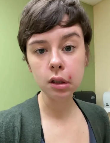 У девушки перекосило лицо от выдавленного прыща Линдси де Оливейра из США выдавила маленький прыщик над уголком губ, замаскир