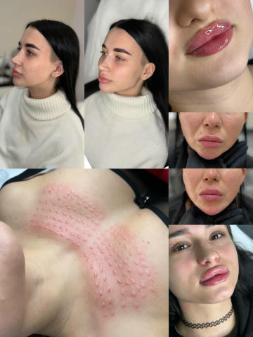 Косметологічні процедури 🗓️Коли? 16.12, 17.12, 18.12, 19.12, 20.12 📍Де? Ⓜ️Позняки 💰Скільки? за препарат !🤯🔥 Jevederm - 5