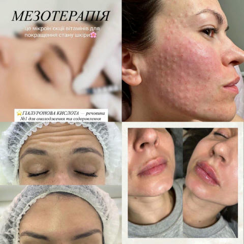 🍎 КОСМЕТОЛОНІЧНІ ПРОЦЕДУРИ 🗓Коли? Дата відкрита 📍Де? 🌏 Вул.Академіка Богомольця 7/ 14 💰Скільки? ☘️Пілінги від 600грн ☘️B