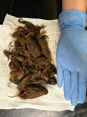 😰На Волині лікарі дістали зі шлунка 7-річної дівчинки майже 700 г волосся Батьки звернулися до медиків після того, як у дити